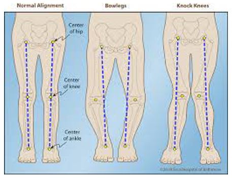 Knee alignment
