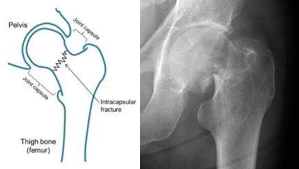 Femoral neck fracture